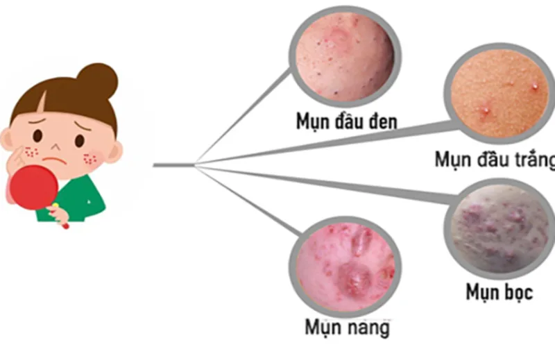 cach cham soc da dau mun hieu qua giup cai thien lan da tu goc