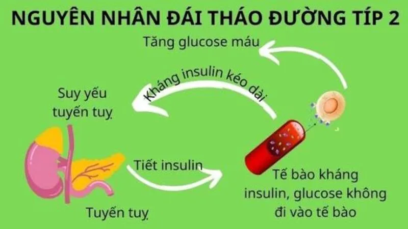 Nguyên nhân tiểu đường Tuýp 2 thường liên quan đến kháng insulin, suy giảm tế bào beta tuyến tụy và nhiều yếu tố chuyển hóa.