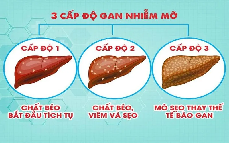 gan nhiem mo co nguy hiem khong cac cap do va nguy co bien chung